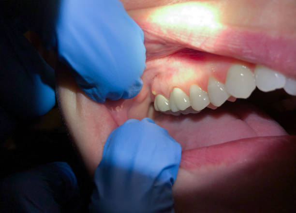 Best Emergency Gum Treatment in Lockport, NY